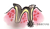 C4・・・骨まで進んだ虫歯
