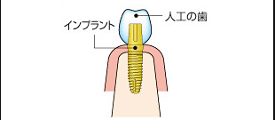 インプラント