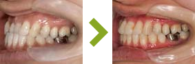 症例：反対咬合