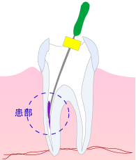 【根管治療】
