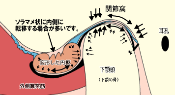 関節円板が前方に転移