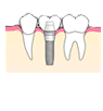 インプラント