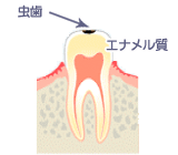 虫歯の進行度 - Ｃ1
