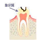 虫歯の進行度 - Ｃ２