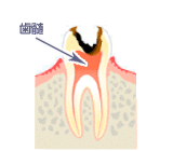 虫歯の進行度 - Ｃ３
