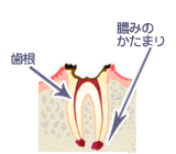 虫歯の進行度 - Ｃ４