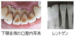 歯周病
