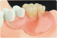 スマートデンチャー